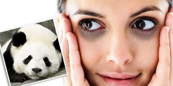 Cara Mengatasi Mata Panda